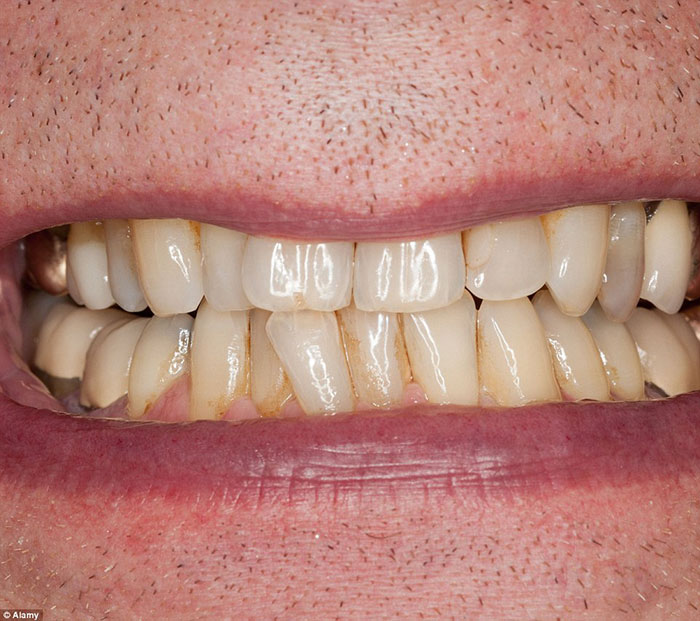 پلاک های زرد رنگ سطح دندان