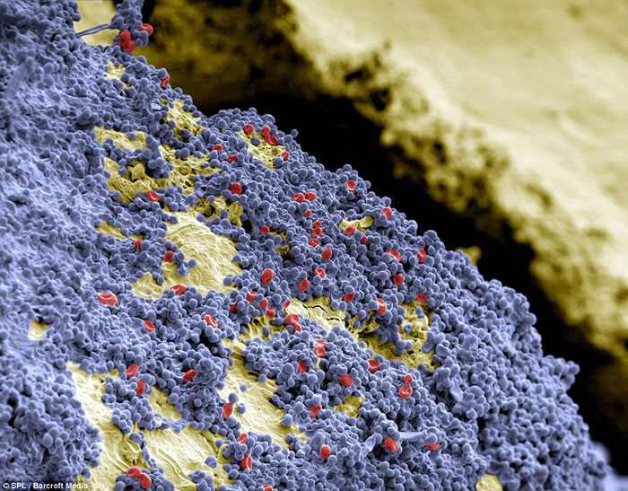  فرش آبی از باکتری های کروی و سلول های قرمز خون چسبیده به سطح دندان زرد