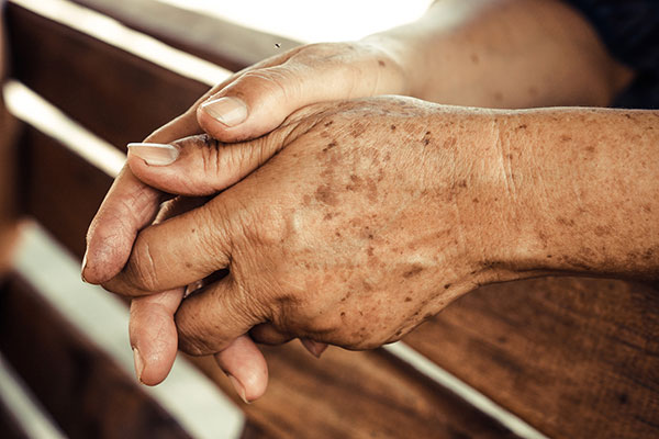 روش های درمان و رفع لکه های قهوه ای روی پوست دست
