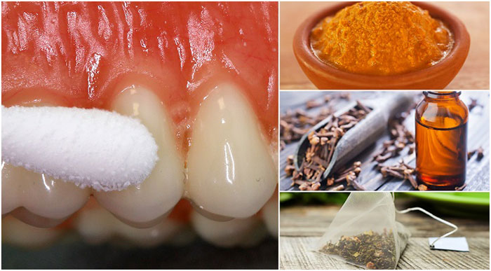 درمان فوری دندان درد شدید با گیاهان دارویی