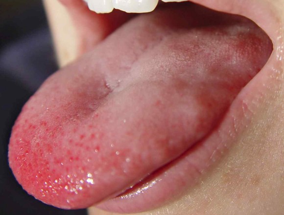 درمان سوختگی زبان