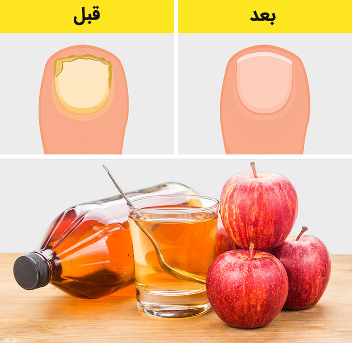 کاربرد سرکه سیب برای عفونت ناخن