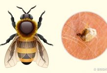 جای نیش زنبور عسل