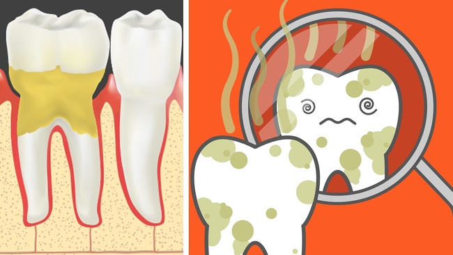 بیماری پیوره یا پیرا دندان آماس - بوی پوسیدگی دندان