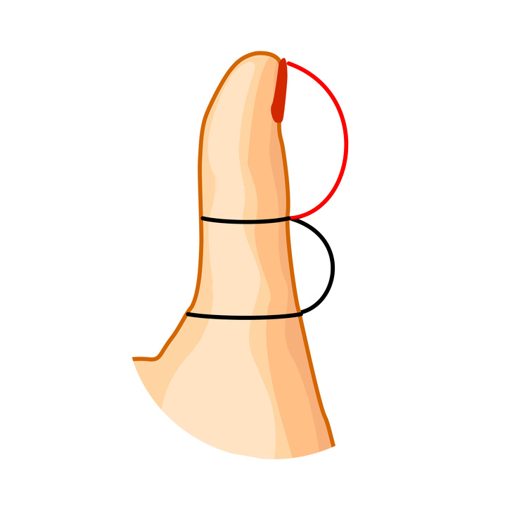 شکل انگشت شست نوع 2 : بند انگشت بالایی بزرگتر از پایینی است