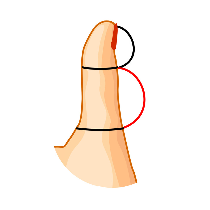 شکل انگشت شست نوع 3 : بند انگشت پایینی بزرگتر از بالایی است