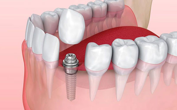 عکس مراحل ایمپلنت دندان